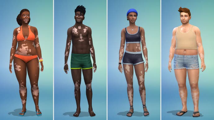 Vitiligo examples in The Sims 4 (body)